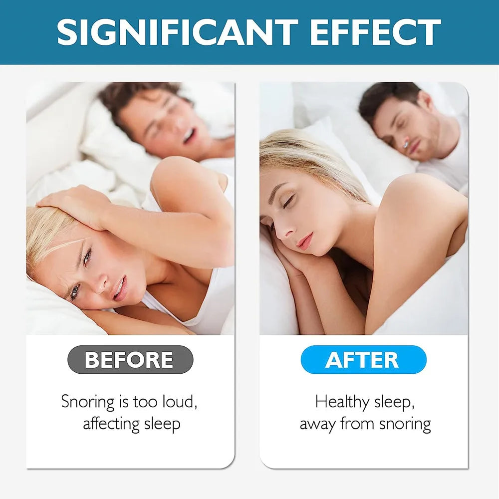 Anti Snoring Device